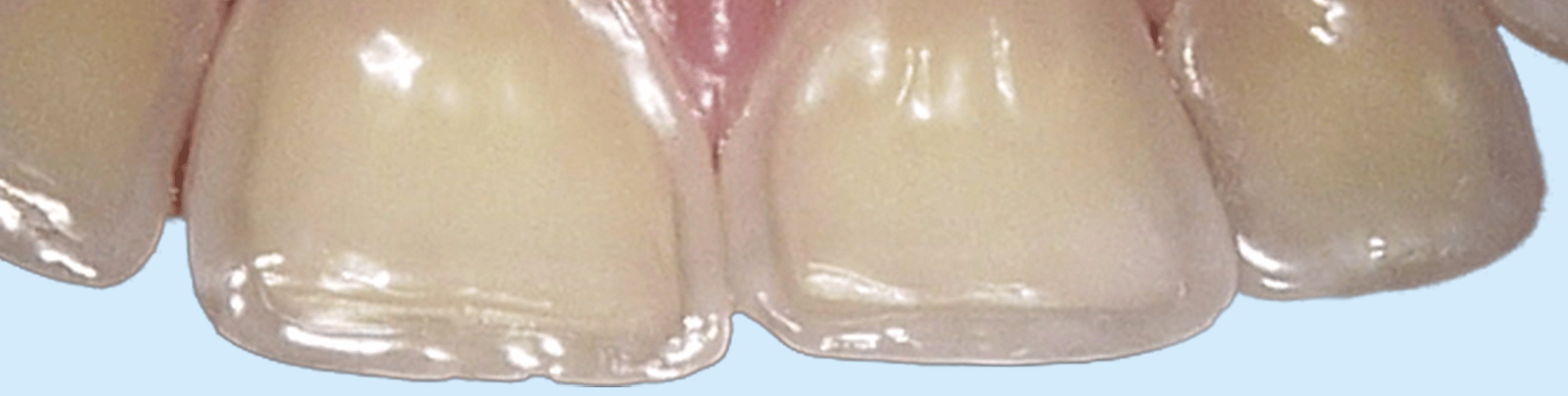 Syreskadede tænder