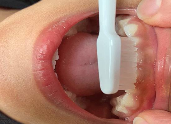 Tandbørstning på barn